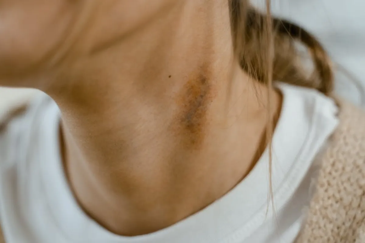 Mild redness after shockwave therapy, a common temporary side effect